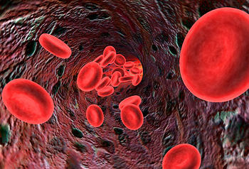 Anemia ferropenica o anemia por carencia hierro